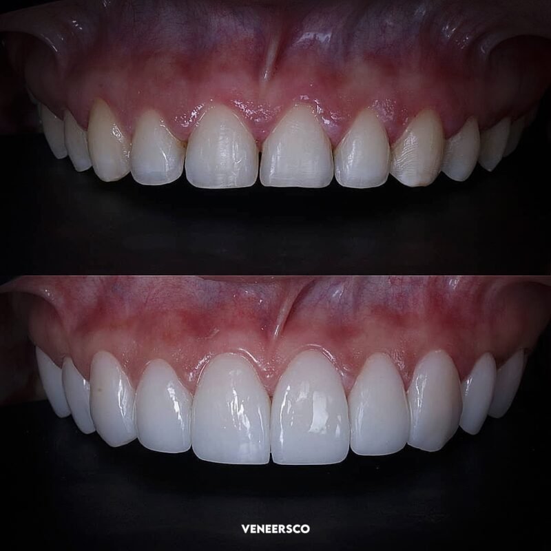 Colombian Composite Veneers | Affordable Smile Makeover