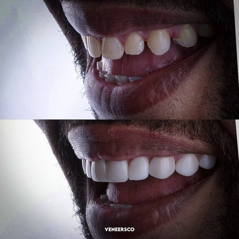 Colombian Porcelain Veneers Affordable Smile Perfection