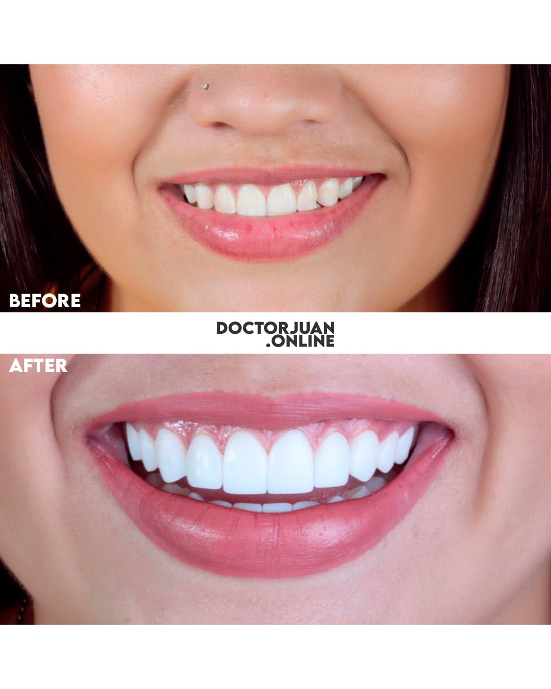 Best Quality Veneers in Colombia, Save up to 70 getting Veneers