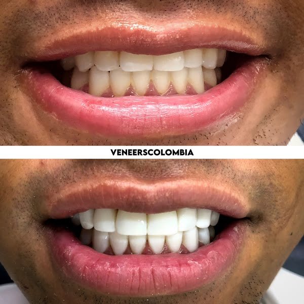 20 Porcelain Veneers in Colombia Cost 6200 Top Dental Clinic