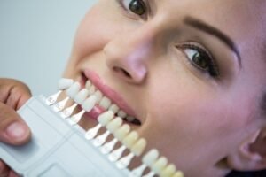 Cost of Veneers