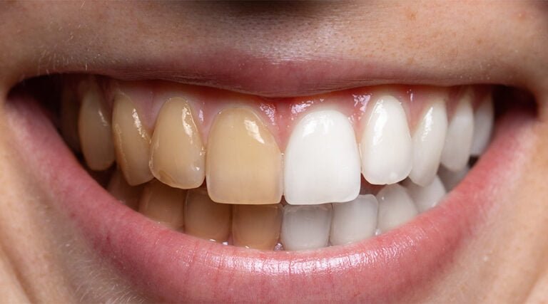 teeth whitening colombia