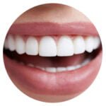 20 Composite Veneers