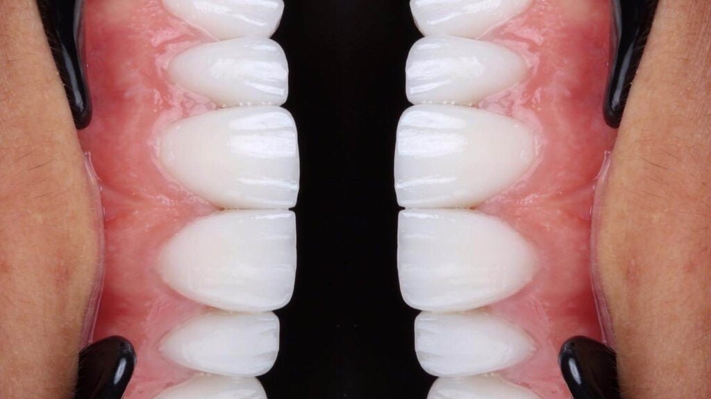 veneers vs crowns