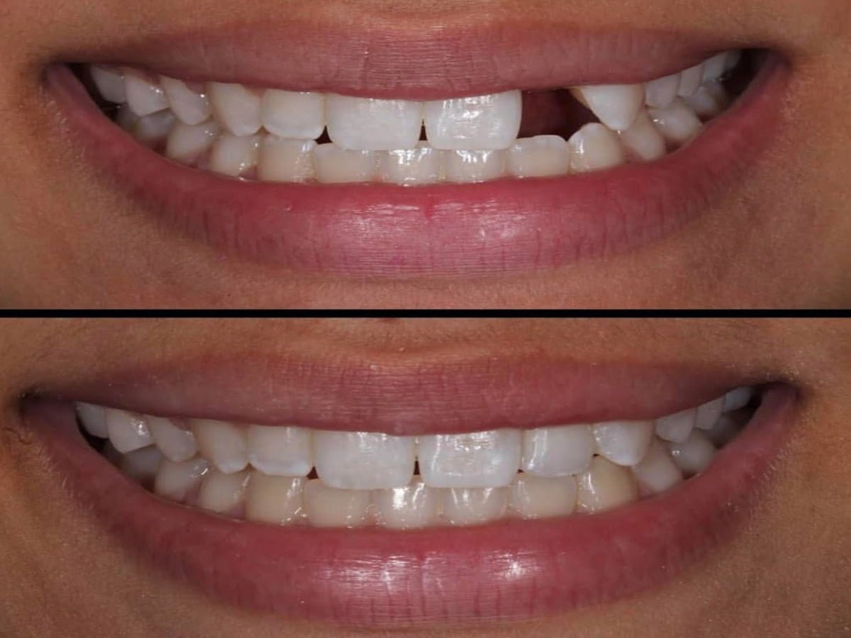 You are currently viewing Can you close teeth gaps with veneers?
