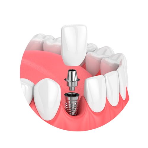 dental implants in colombia