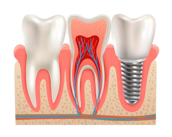 dental implants in Colombia