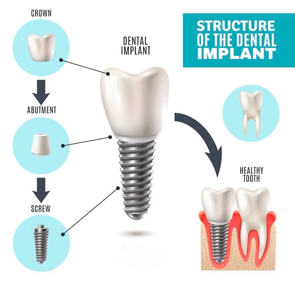 dental implants in Colombia