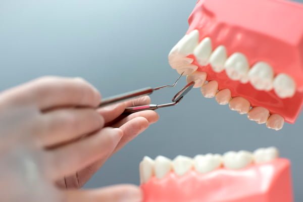 dental implants in Colombia