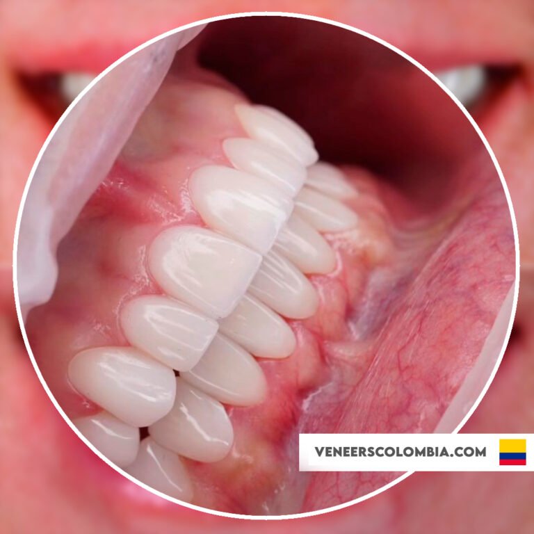 20 Porcelain Veneers in Colombia