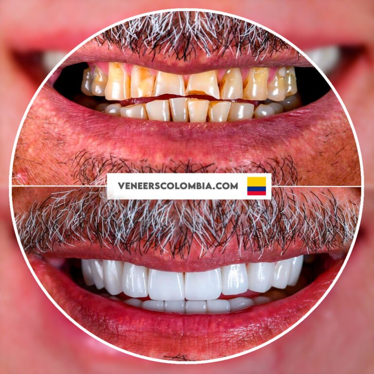 Patient's journey to a brighter smile with porcelain veneers in Colombia, shown in before and after photos.
