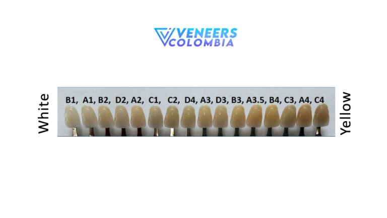 Veneers Color Chart Selecting The Perfect Shade For Your Tooth 7912