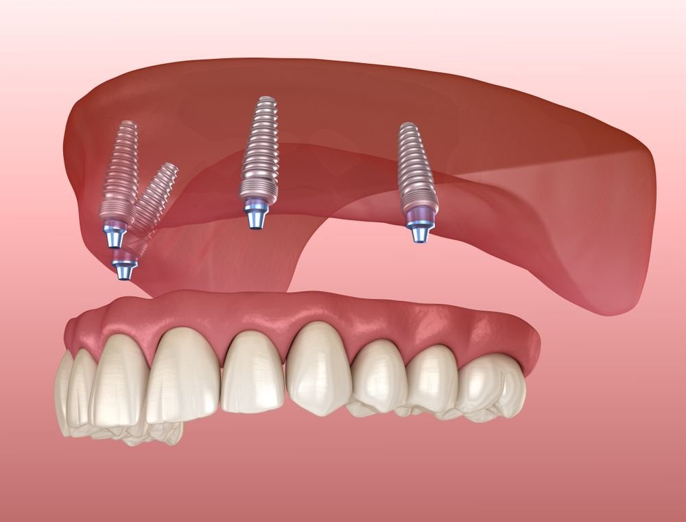 dental implants in colombia medellin