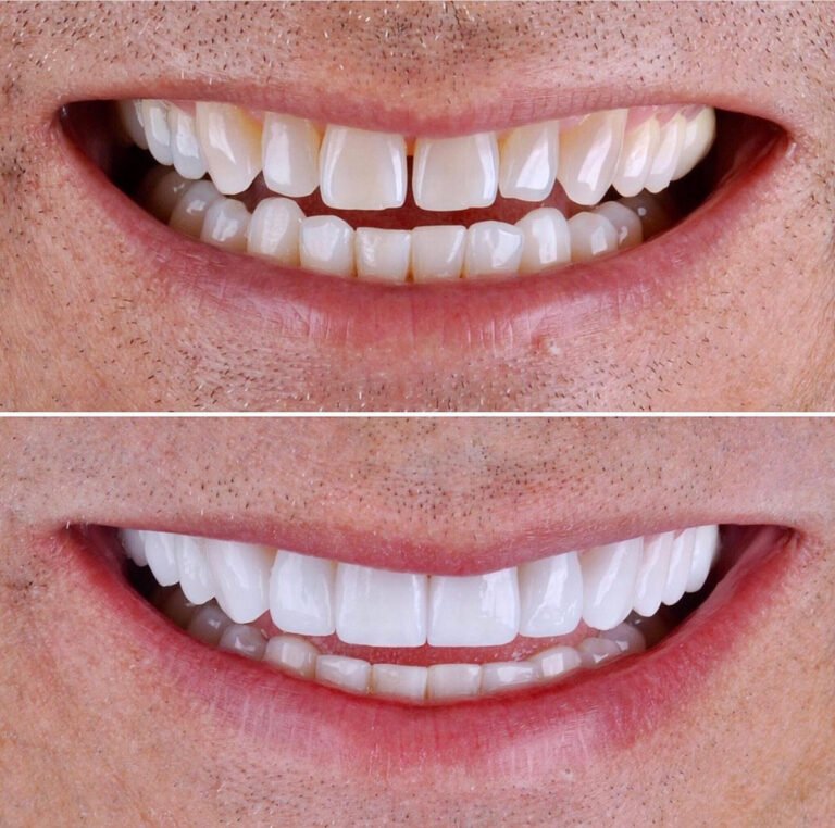 emax veneers