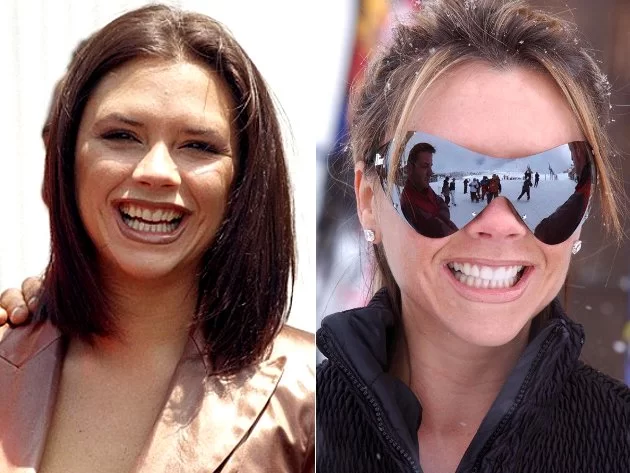 Victoria Beckham veneers