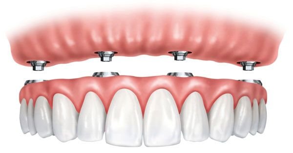 Read more about the article Getting “All-On-4” Dental Implants in Colombia