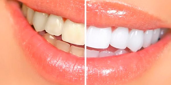 teeth whitening in colombia