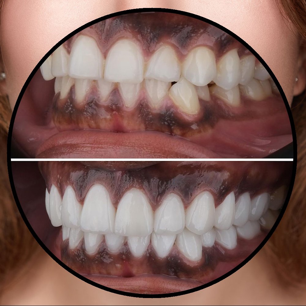 Colombian veneers before and after comparison