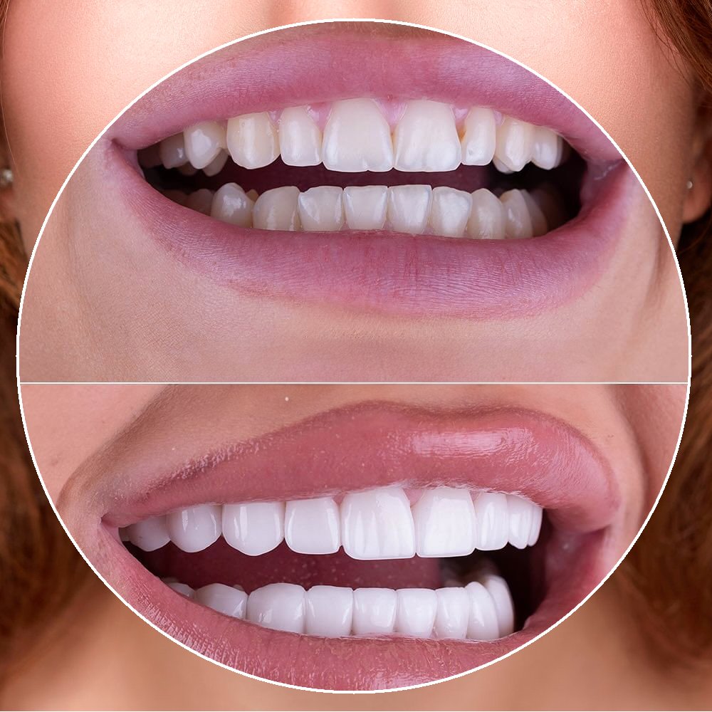 Colombian dental makeover before and after veneers