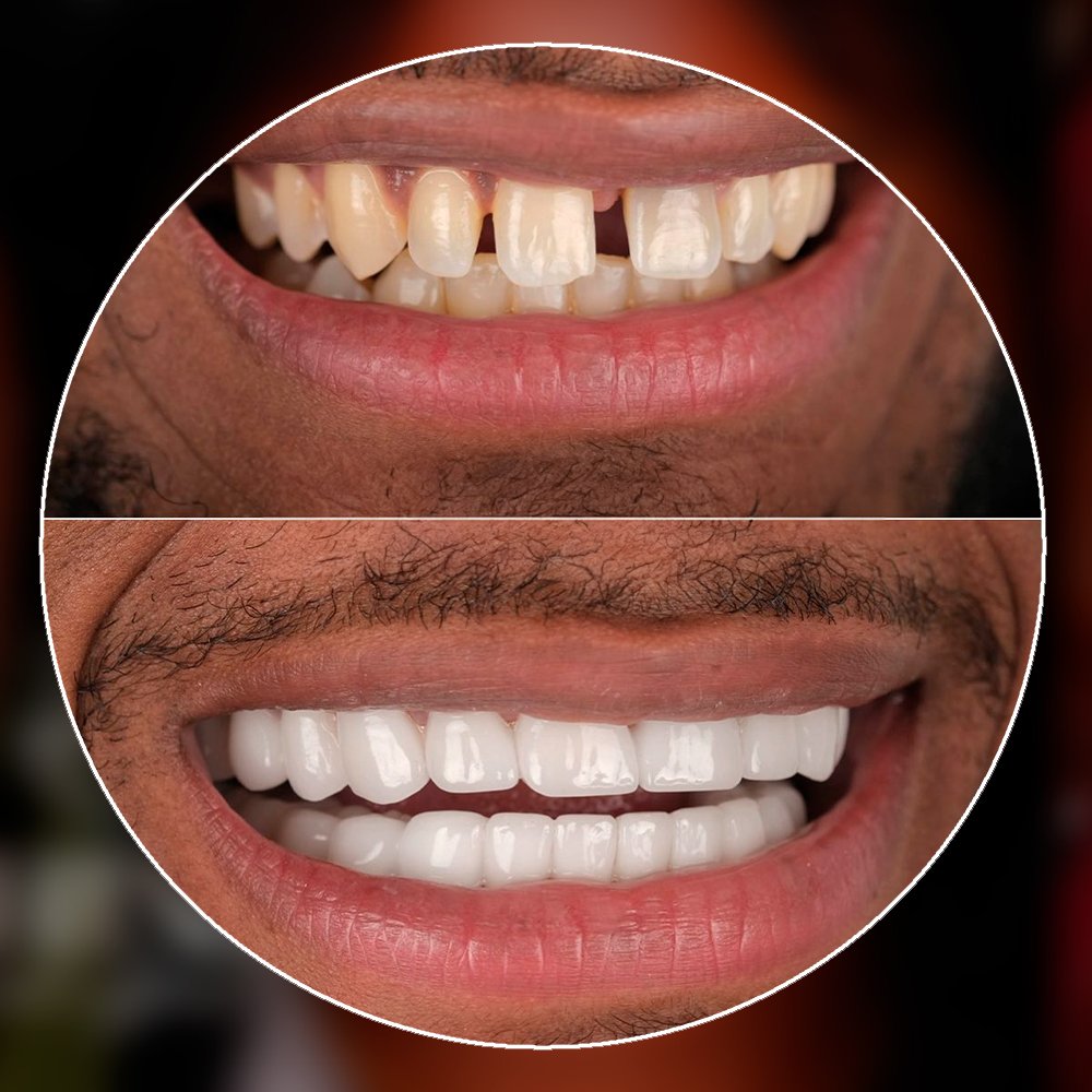 Smile makeover before and after with veneers in Colombia