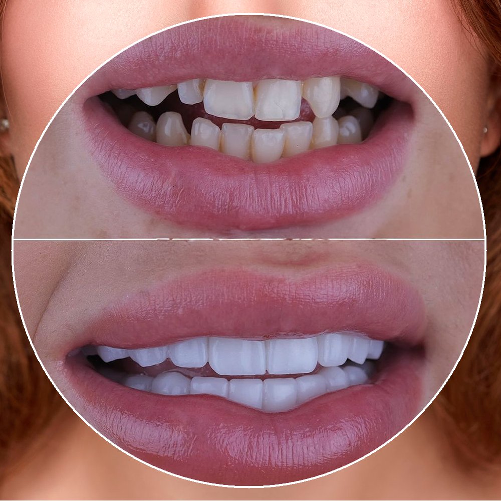 Before and after results with Colombian veneers