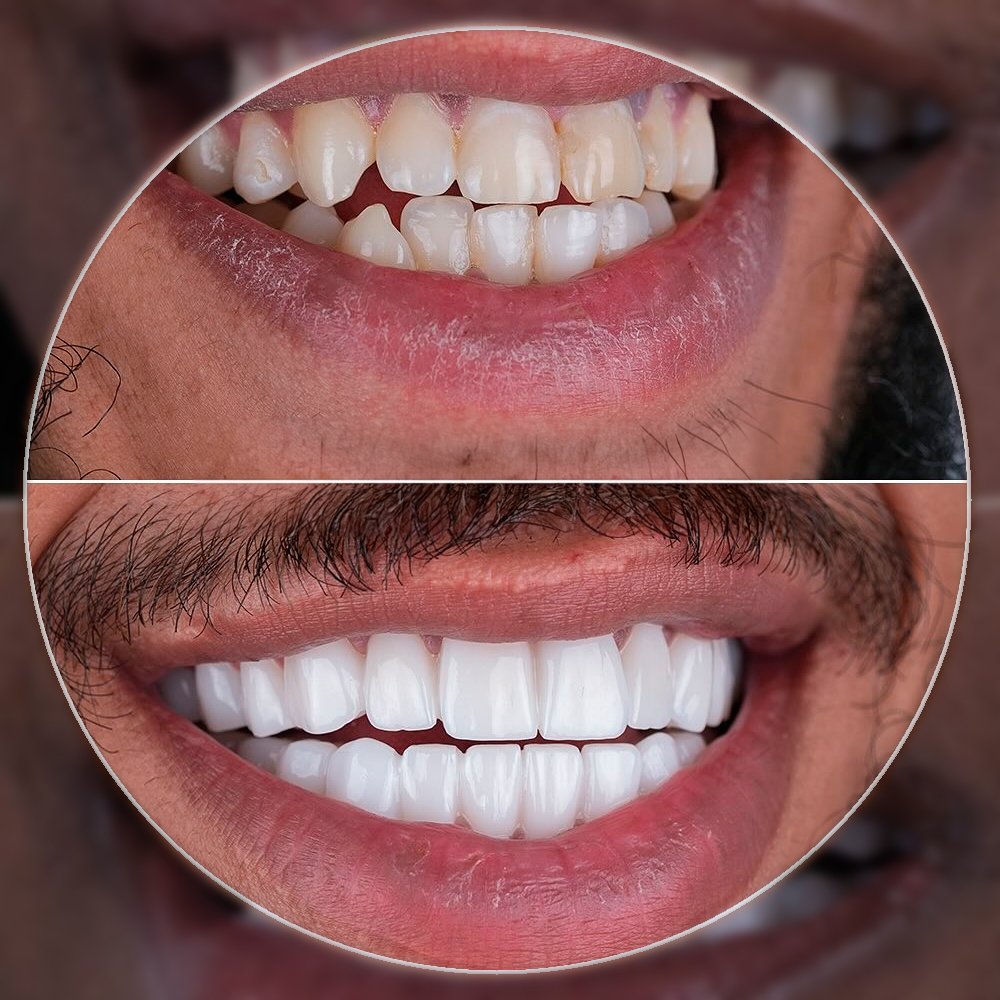 Dramatic veneers transformation before and after