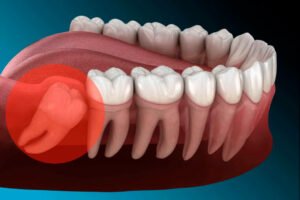 Illustration of a wisdom tooth (cordal) partially erupted in the gum, highlighting its position at the back of the jaw