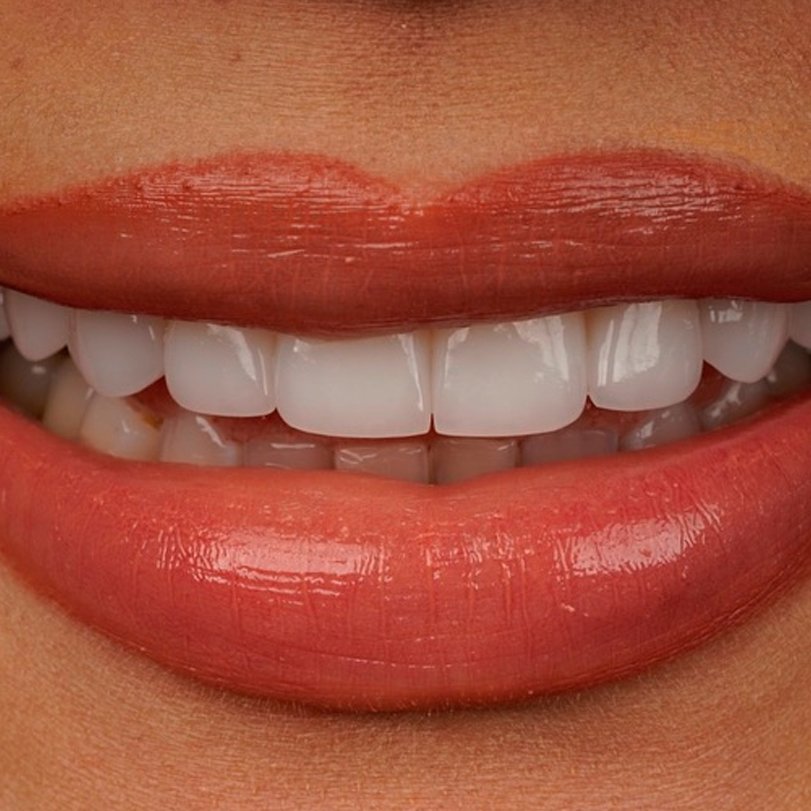 Composite Veneers