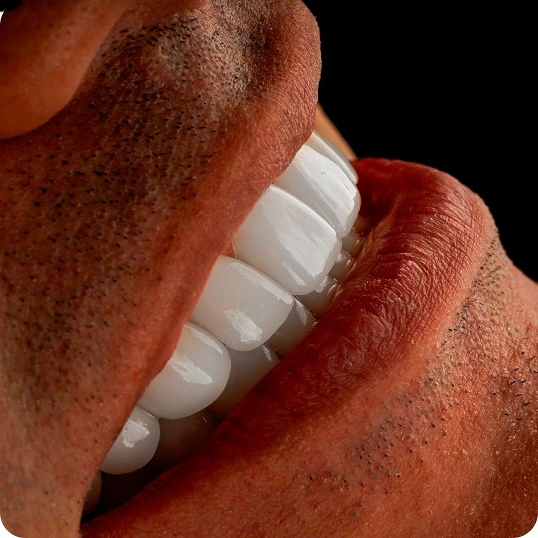Porcelain Veneers