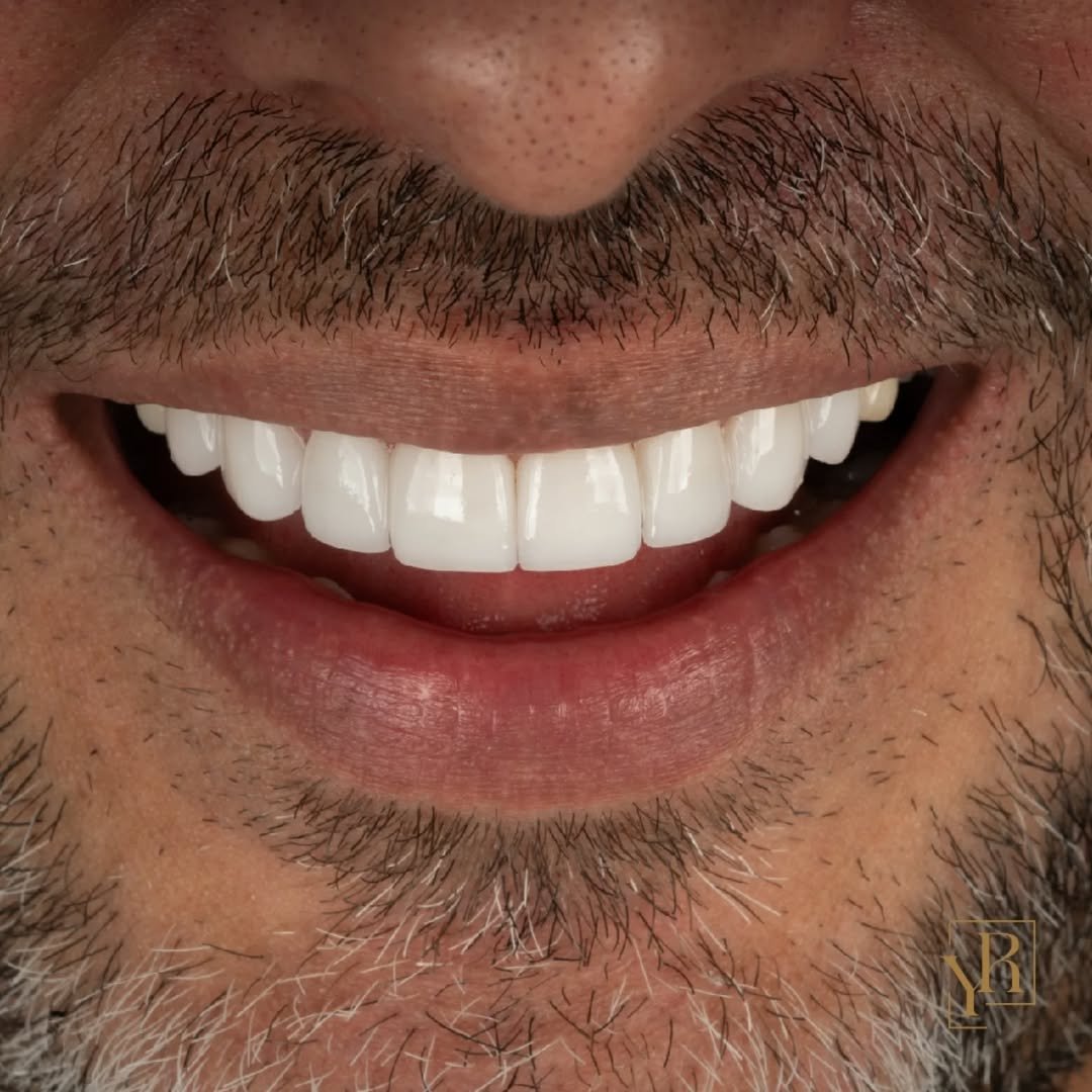 Porcelain-Veneers (1)
